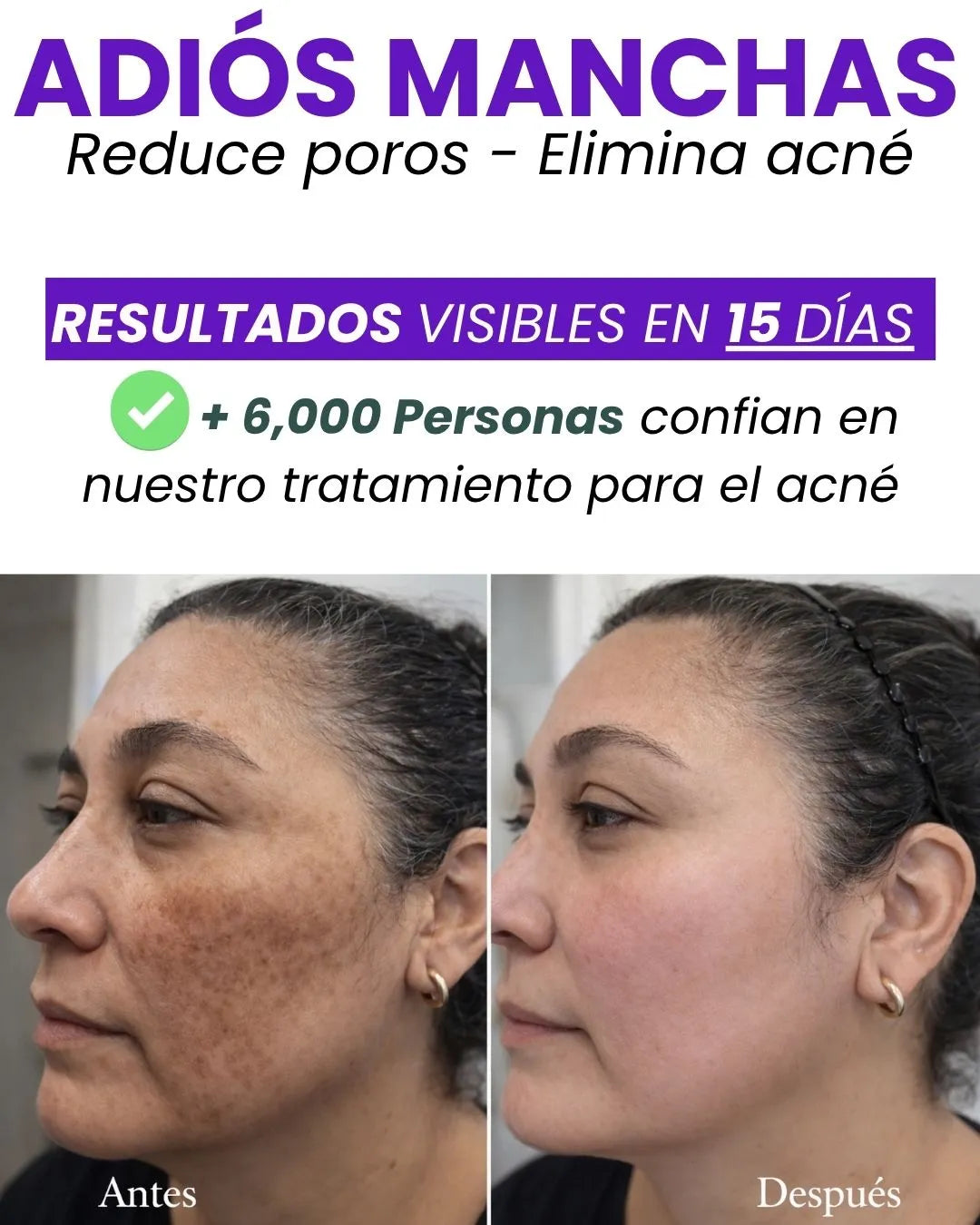 KIT ADIÓS MANCHAS Y ACNÉ +OBSEQUIO TIENDA OFICIAL