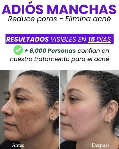 KIT ADIÓS MANCHAS Y ACNÉ +OBSEQUIO TIENDA OFICIAL